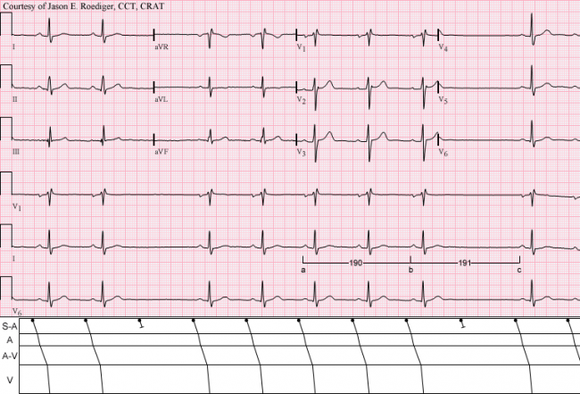 sick-sinus-syndrome-ecg-guru-instructor-resources